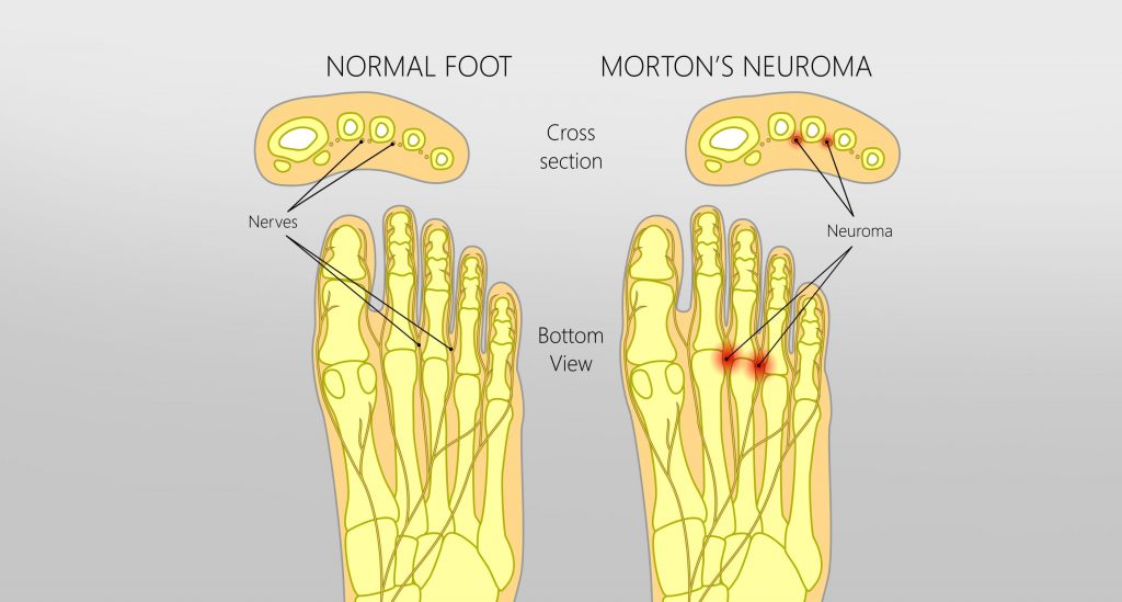 Morton's Neuroma Mind Heart Body Centre