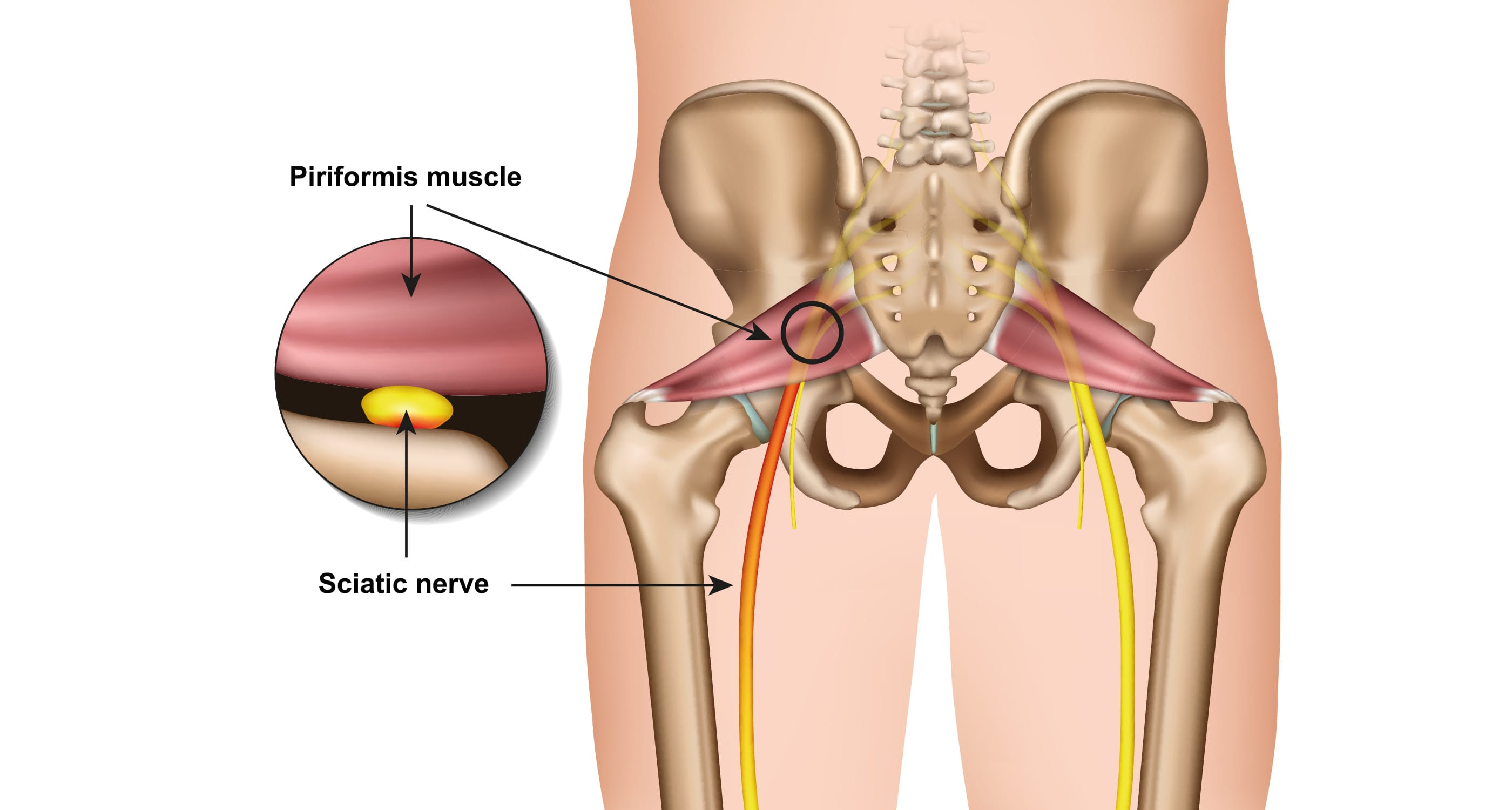 Sciatica Vs Piriformis Syndrome Mind Heart Body Centre